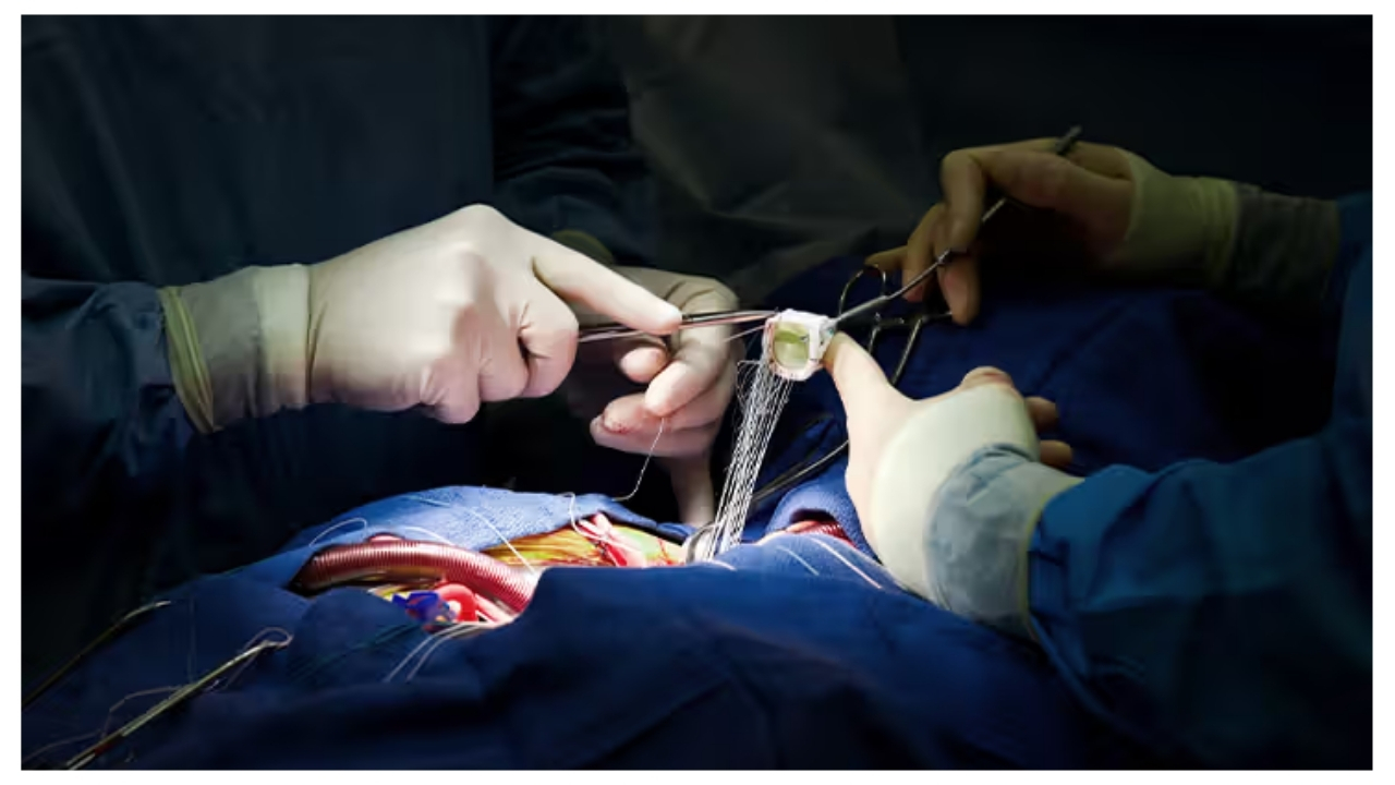 Cardiac Surgery